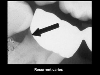 Caries Code R1 radiographic-caries-diagnosis | PDF