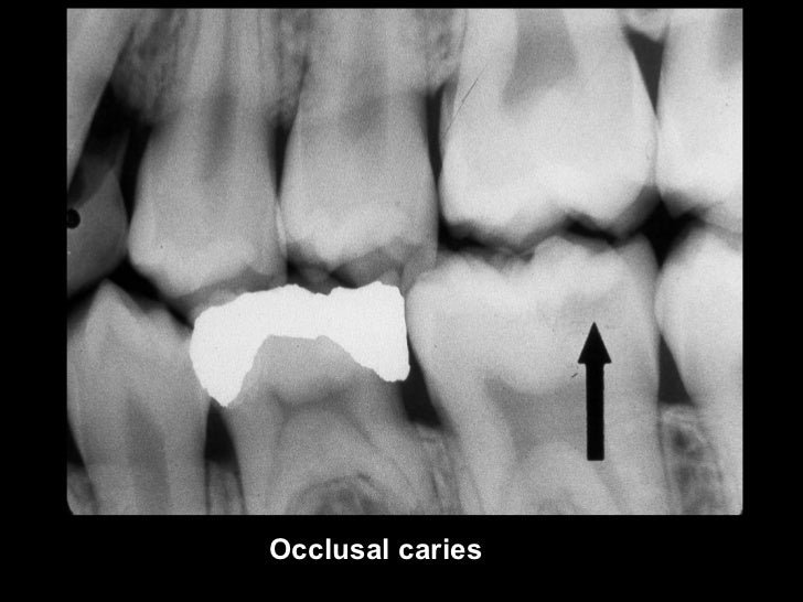 radiographic-caries-diagnosis