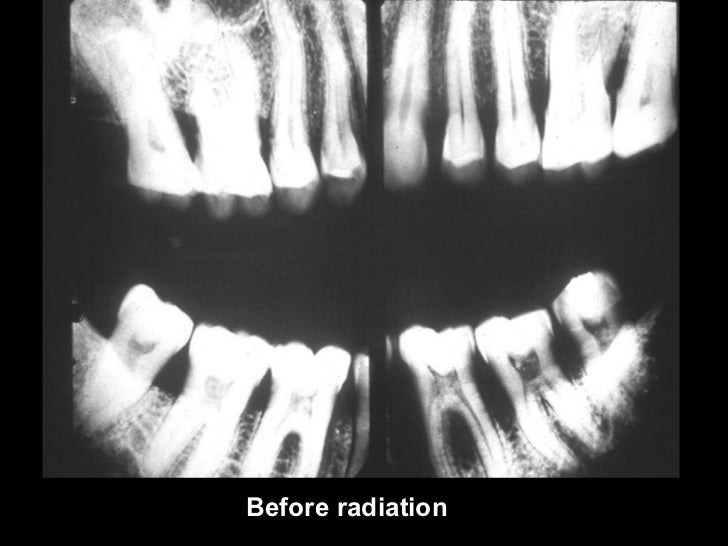 radiographiccariesdiagnosis