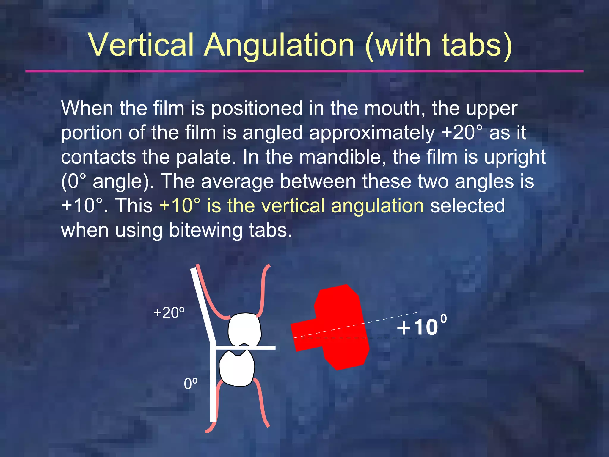 Vertical Angulation (with tabs)
When the film is positioned in the mouth, the upper
portion of the film is angled approximately +20° as it
contacts the palate. In the mandible, the film is upright
(0° angle). The average between these two angles is
+10°. This +10° is the vertical angulation selected
when using bitewing tabs.


          +20º



              0º
 