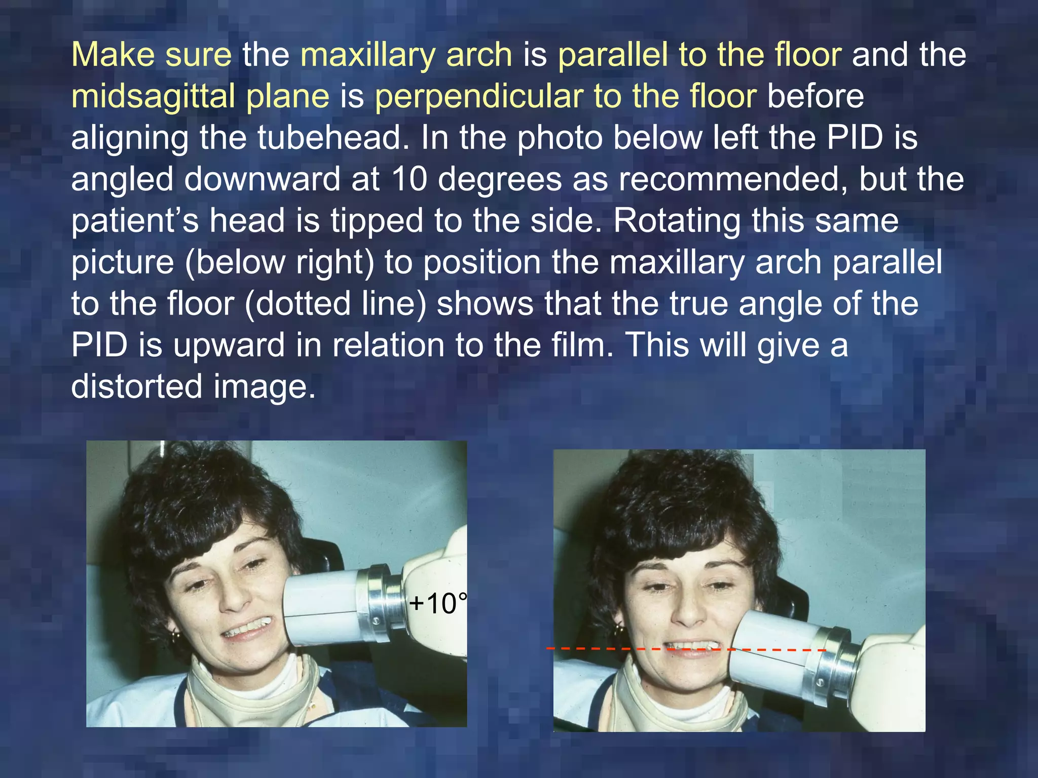 Make sure the maxillary arch is parallel to the floor and the
midsagittal plane is perpendicular to the floor before
aligning the tubehead. In the photo below left the PID is
angled downward at 10 degrees as recommended, but the
patient’s head is tipped to the side. Rotating this same
picture (below right) to position the maxillary arch parallel
to the floor (dotted line) shows that the true angle of the
PID is upward in relation to the film. This will give a
distorted image.




                      +10°
 