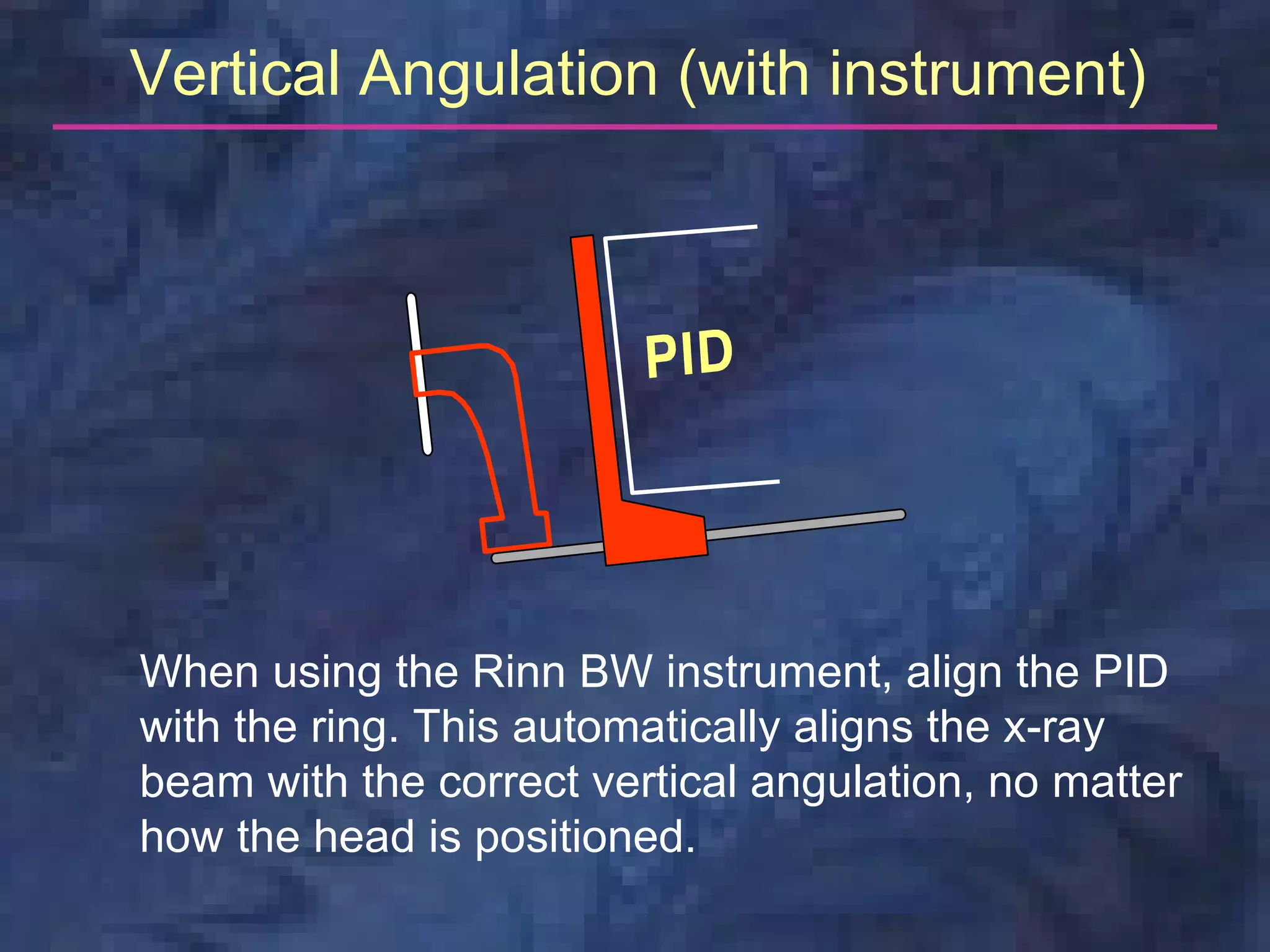 Vertical Angulation (with instrument)




When using the Rinn BW instrument, align the PID
with the ring. This automatically aligns the x-ray
beam with the correct vertical angulation, no matter
how the head is positioned.
 