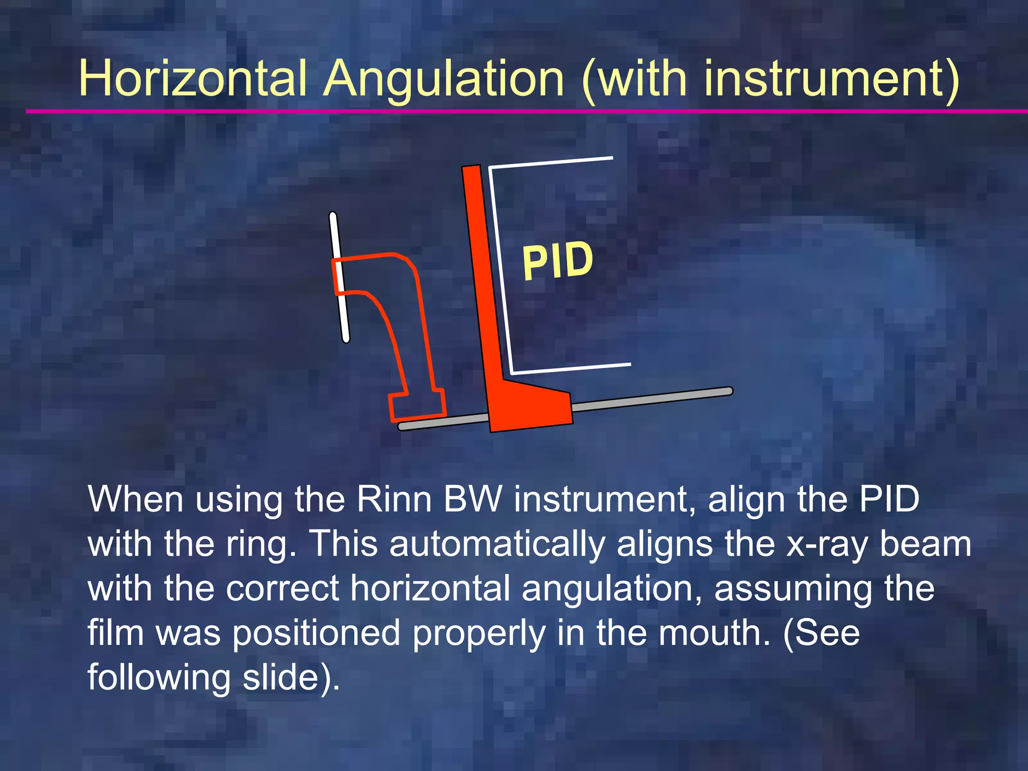 Horizontal Angulation (with instrument)




When using the Rinn BW instrument, align the PID
with the ring. This automatically aligns the x-ray beam
with the correct horizontal angulation, assuming the
film was positioned properly in the mouth. (See
following slide).
 