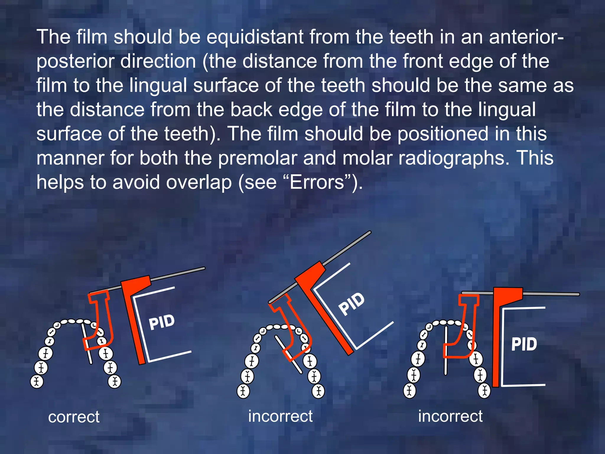 The film should be equidistant from the teeth in an anterior-
posterior direction (the distance from the front edge of the
film to the lingual surface of the teeth should be the same as
the distance from the back edge of the film to the lingual
surface of the teeth). The film should be positioned in this
manner for both the premolar and molar radiographs. This
helps to avoid overlap (see “Errors”).




 correct                incorrect           incorrect
 