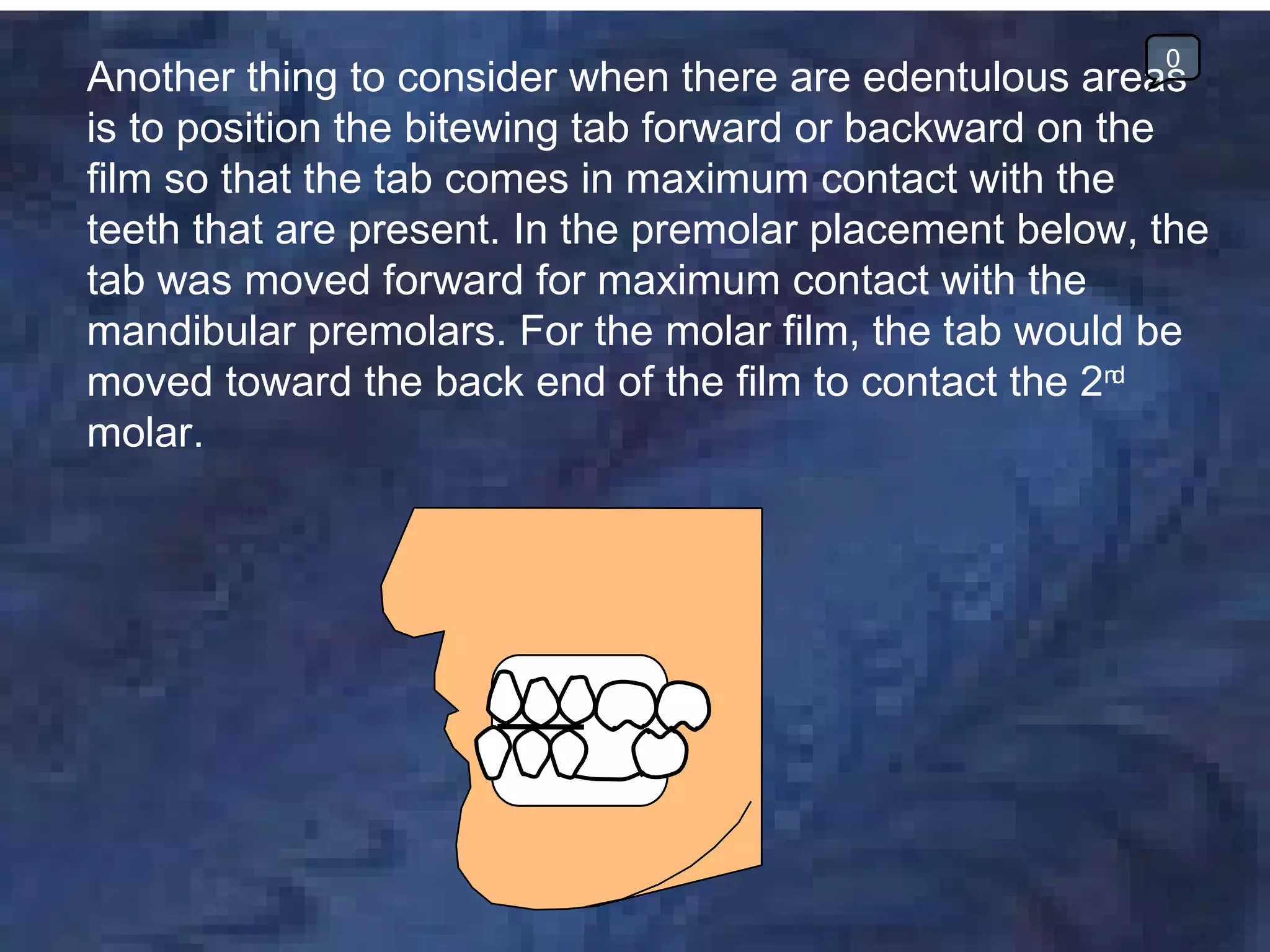 0
Another thing to consider when there are edentulous areas
is to position the bitewing tab forward or backward on the
film so that the tab comes in maximum contact with the
teeth that are present. In the premolar placement below, the
tab was moved forward for maximum contact with the
mandibular premolars. For the molar film, the tab would be
moved toward the back end of the film to contact the 2nd
molar.
 