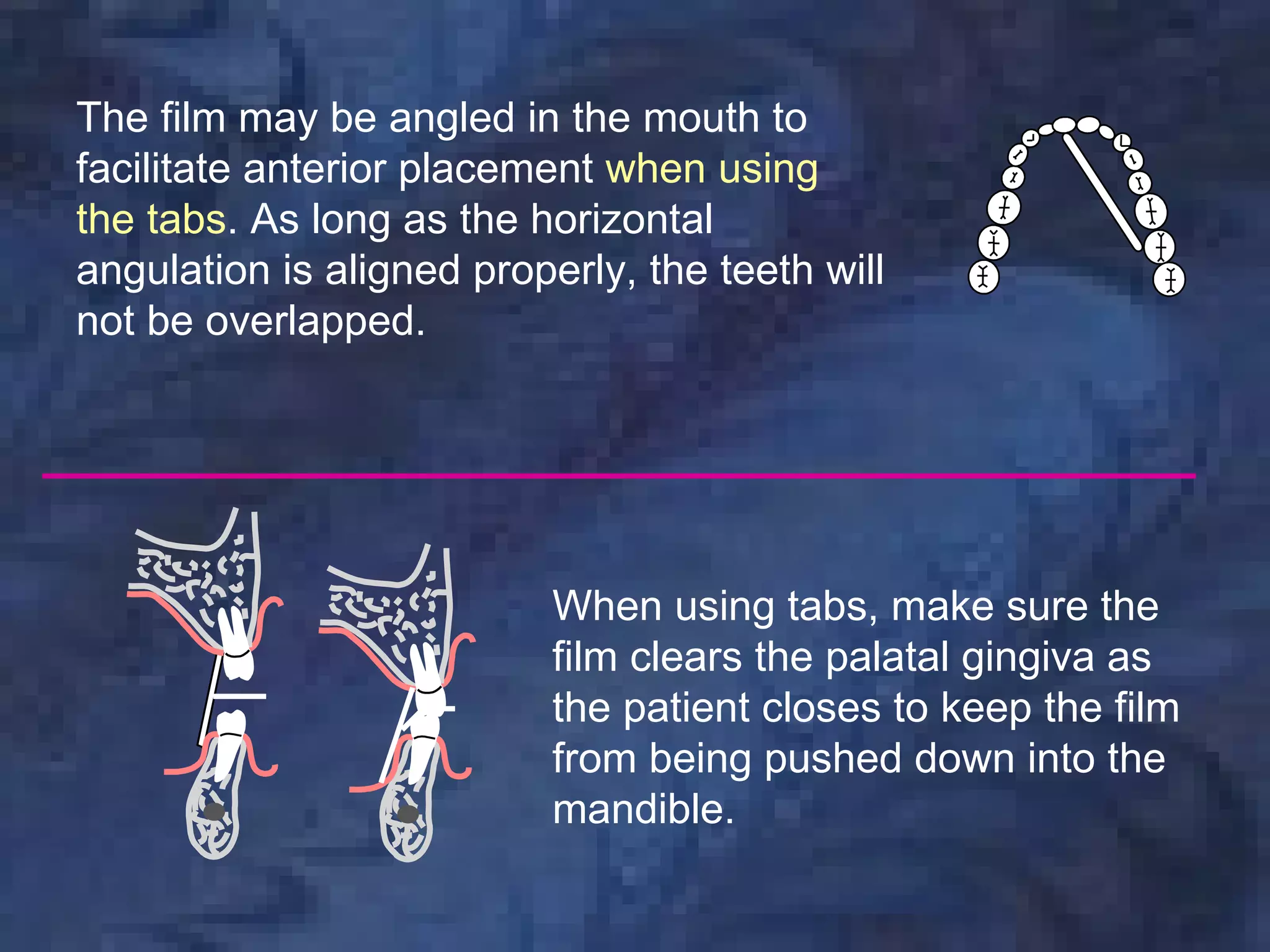 The film may be angled in the mouth to
facilitate anterior placement when using
the tabs. As long as the horizontal
angulation is aligned properly, the teeth will
not be overlapped.




                           When using tabs, make sure the
                           film clears the palatal gingiva as
                           the patient closes to keep the film
                           from being pushed down into the
                           mandible.
 