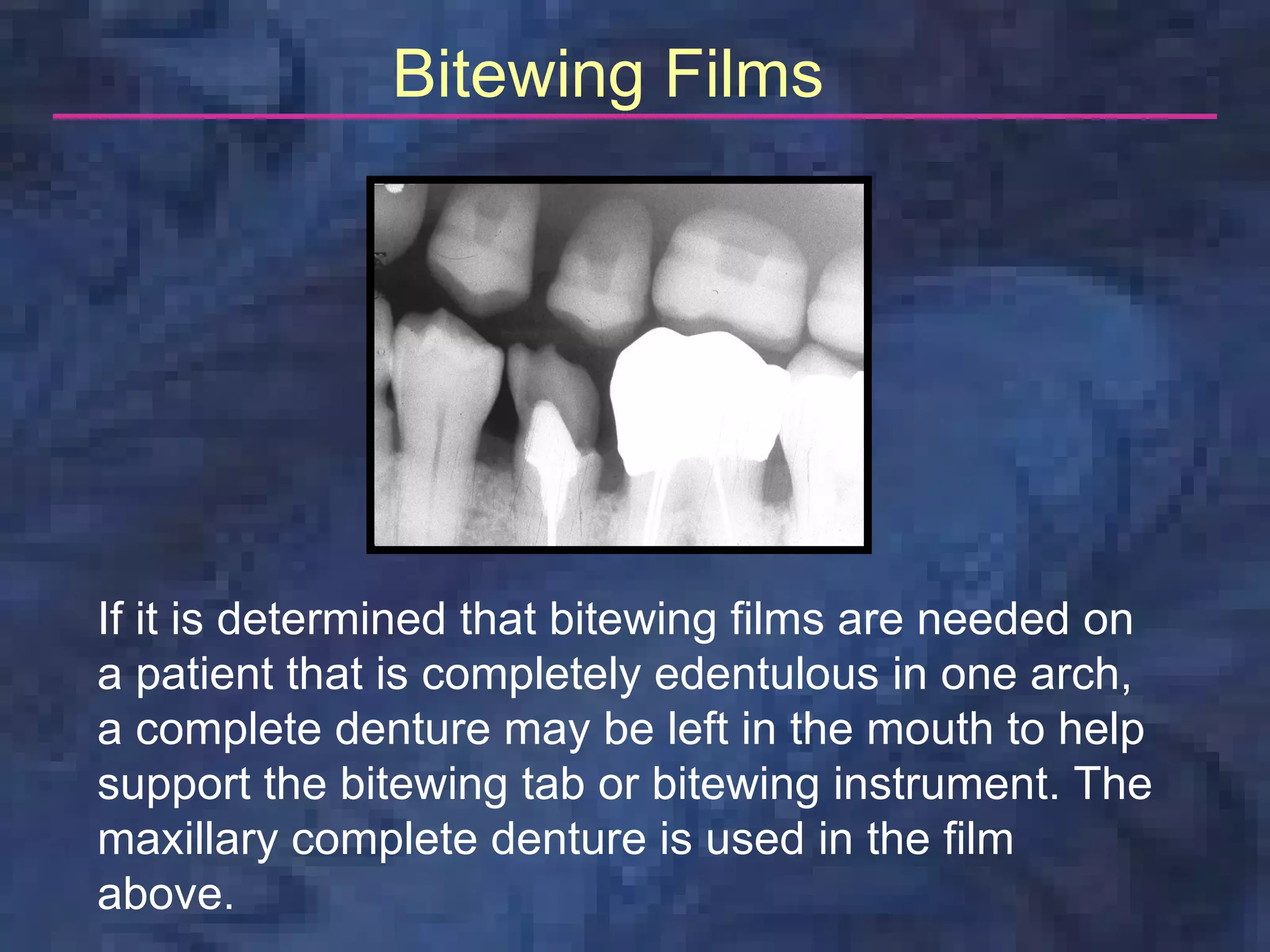 Bitewing Films




If it is determined that bitewing films are needed on
a patient that is completely edentulous in one arch,
a complete denture may be left in the mouth to help
support the bitewing tab or bitewing instrument. The
maxillary complete denture is used in the film
above.
 