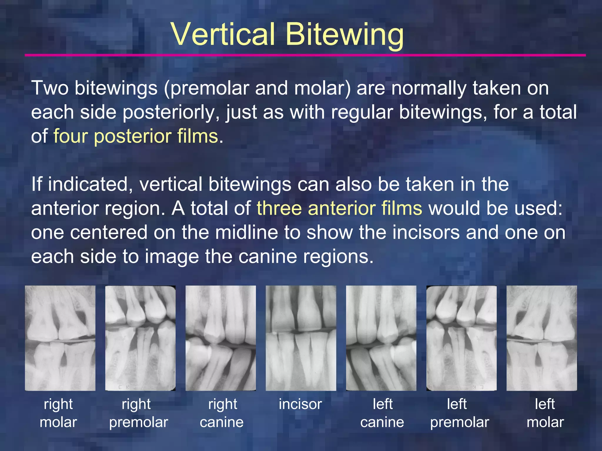 Vertical Bitewing
Two bitewings (premolar and molar) are normally taken on
each side posteriorly, just as with regular bitewings, for a total
of four posterior films.

If indicated, vertical bitewings can also be taken in the
anterior region. A total of three anterior films would be used:
one centered on the midline to show the incisors and one on
each side to image the canine regions.




 right     right       right   incisor     left     left      left
 molar   premolar     canine             canine   premolar   molar
 