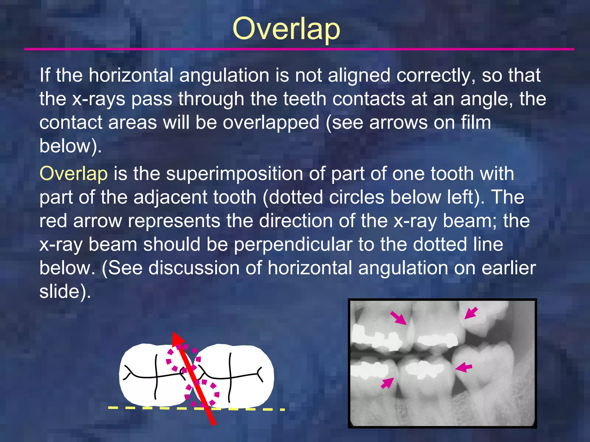 Overlap
If the horizontal angulation is not aligned correctly, so that
the x-rays pass through the teeth contacts at an angle, the
contact areas will be overlapped (see arrows on film
below).
Overlap is the superimposition of part of one tooth with
part of the adjacent tooth (dotted circles below left). The
red arrow represents the direction of the x-ray beam; the
x-ray beam should be perpendicular to the dotted line
below. (See discussion of horizontal angulation on earlier
slide).
 