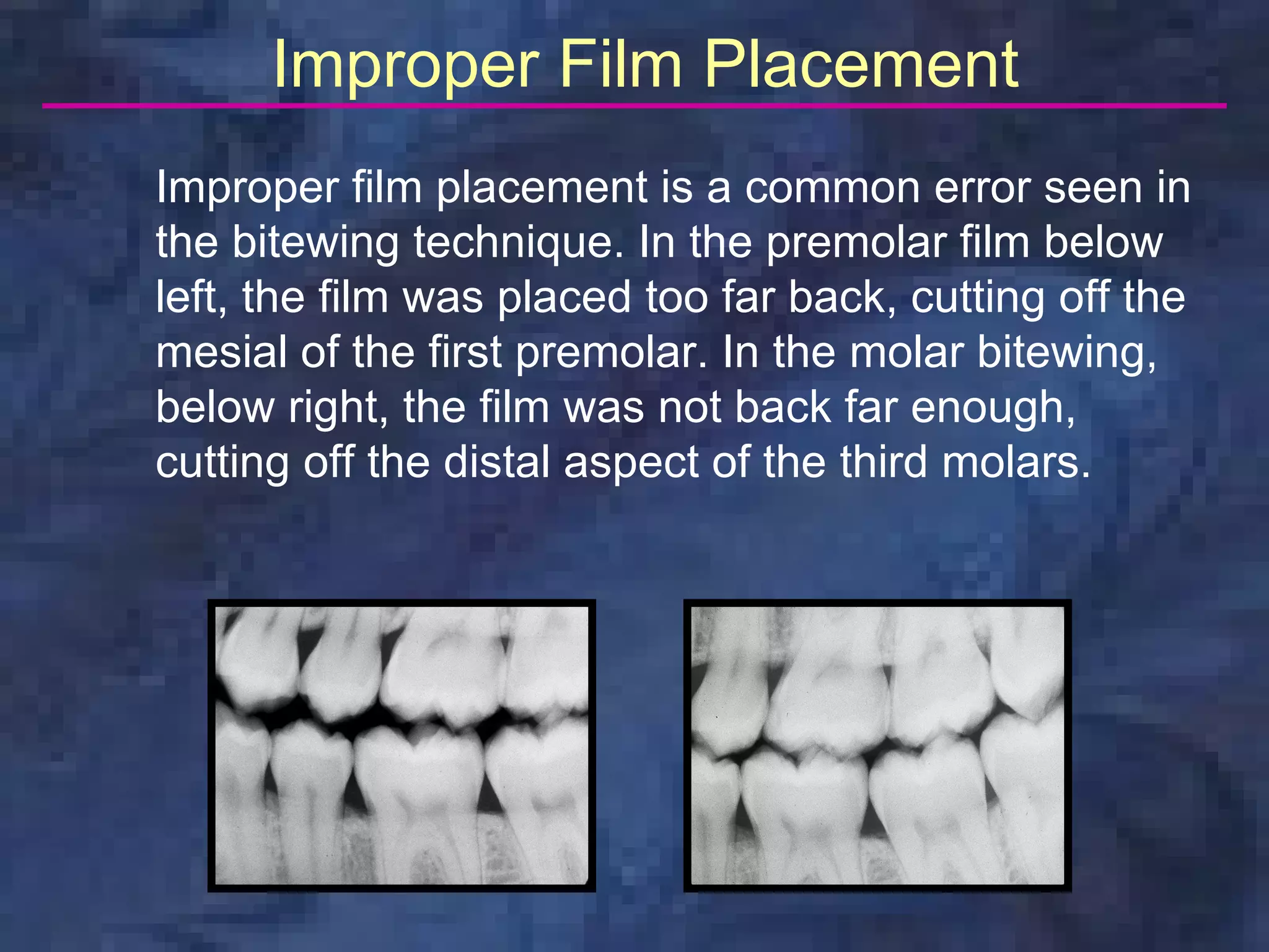 radiologybitewingtechnique PPT