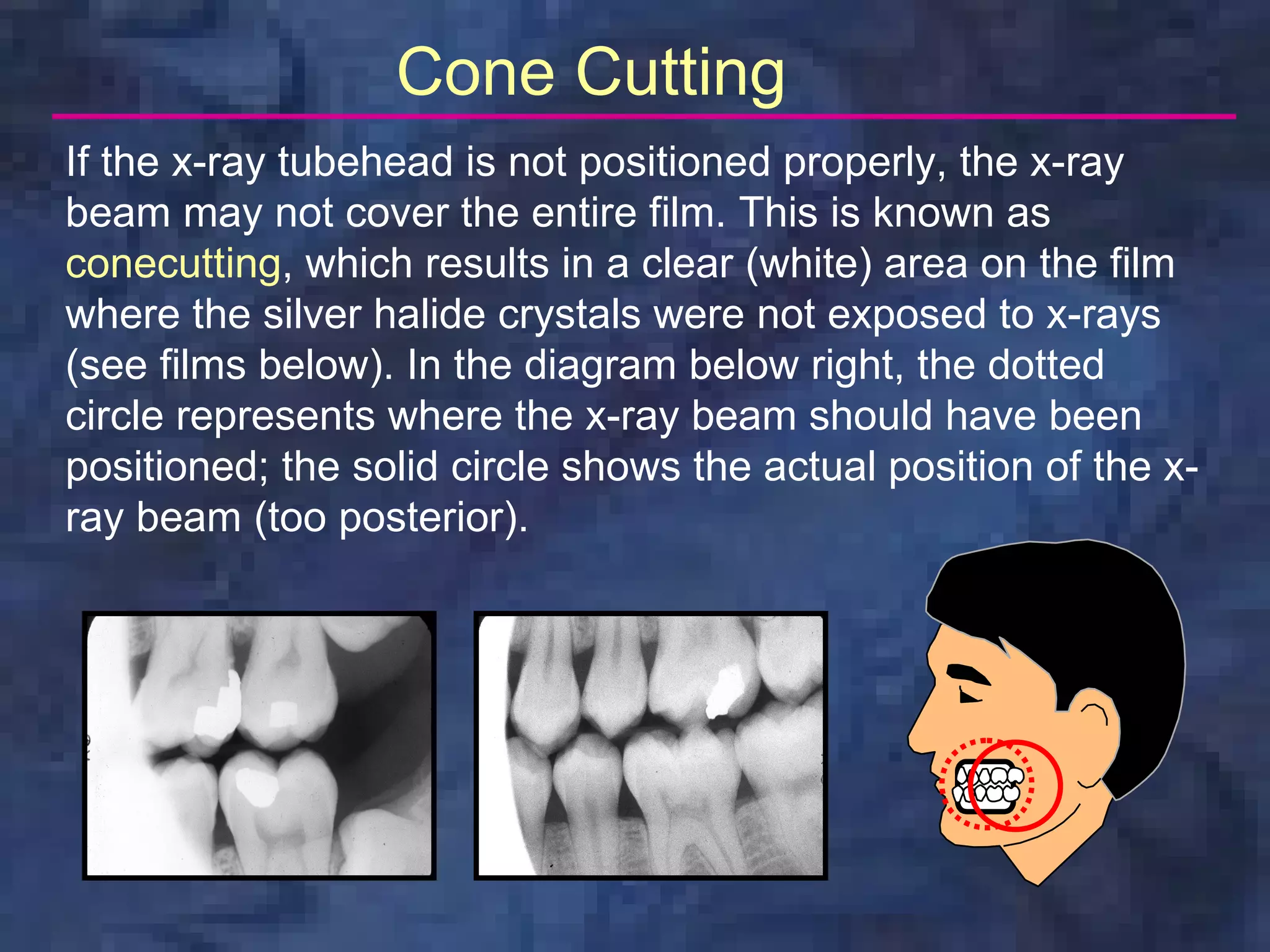Cone Cutting
If the x-ray tubehead is not positioned properly, the x-ray
beam may not cover the entire film. This is known as
conecutting, which results in a clear (white) area on the film
where the silver halide crystals were not exposed to x-rays
(see films below). In the diagram below right, the dotted
circle represents where the x-ray beam should have been
positioned; the solid circle shows the actual position of the x-
ray beam (too posterior).
 