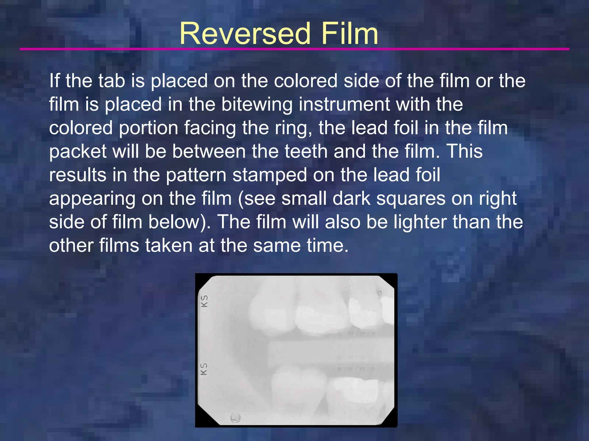 Reversed Film                                 0



If the tab is placed on the colored side of the film or the
film is placed in the bitewing instrument with the
colored portion facing the ring, the lead foil in the film
packet will be between the teeth and the film. This
results in the pattern stamped on the lead foil
appearing on the film (see small dark squares on right
side of film below). The film will also be lighter than the
other films taken at the same time.
 