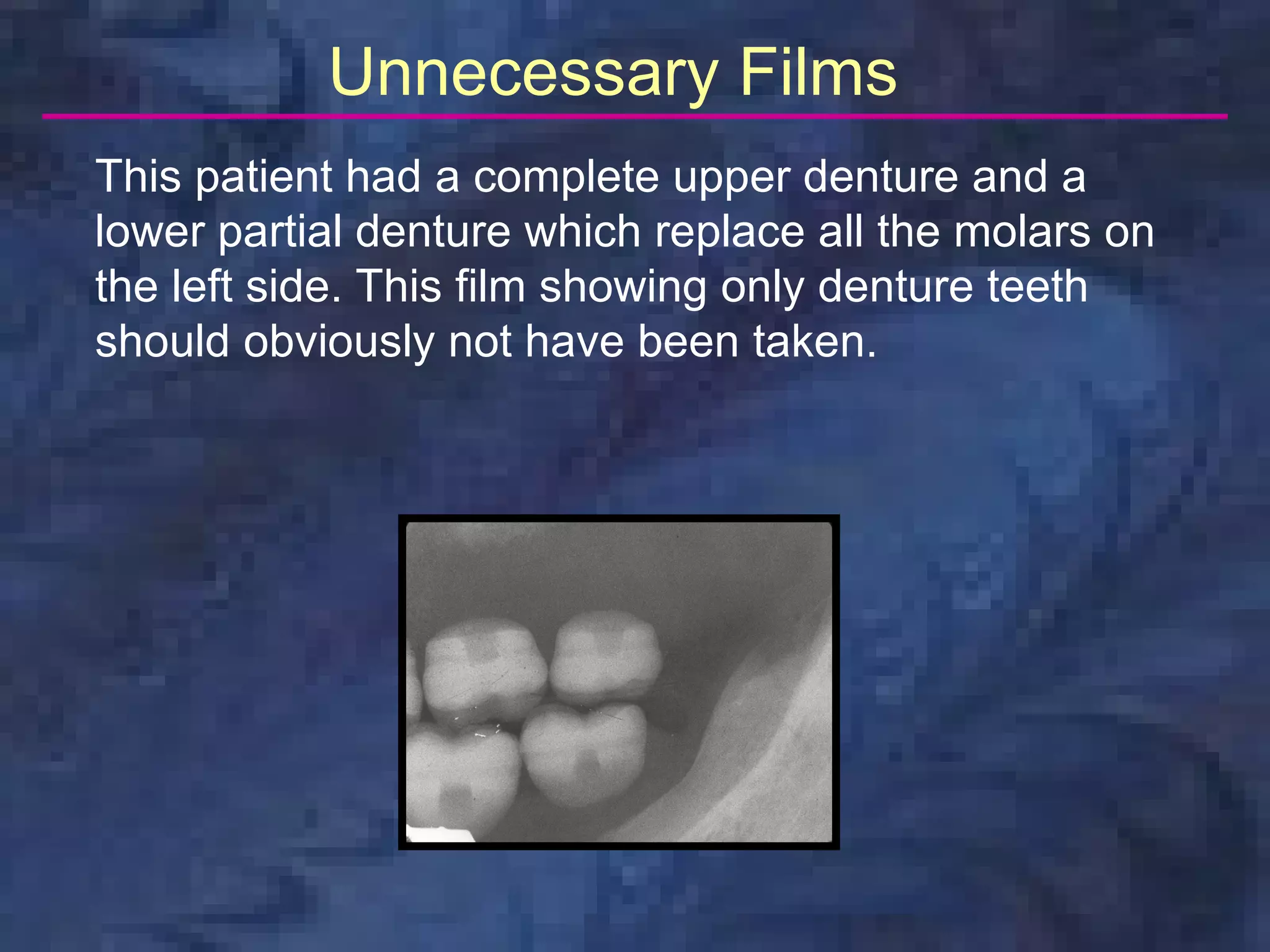 Unnecessary Films
This patient had a complete upper denture and a
lower partial denture which replace all the molars on
the left side. This film showing only denture teeth
should obviously not have been taken.
 