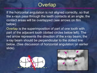Bitewing Radiography Pdf radiology-bitewing-technique | PDF