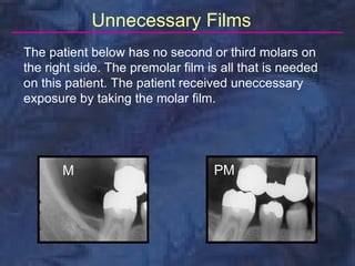radiology-bitewing-technique | PDF