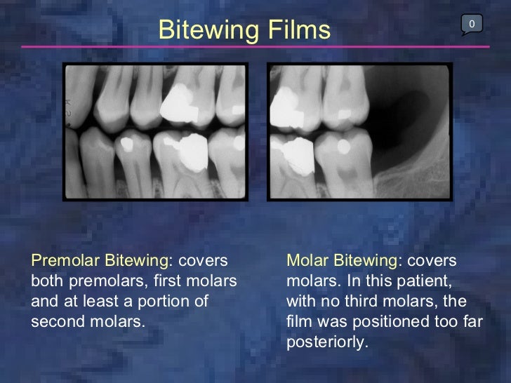 radiologybitewingtechnique