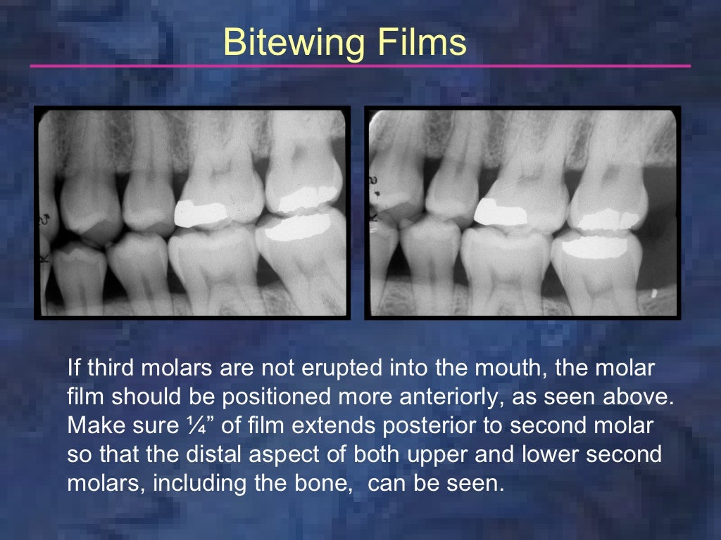 radiologybitewingtechnique