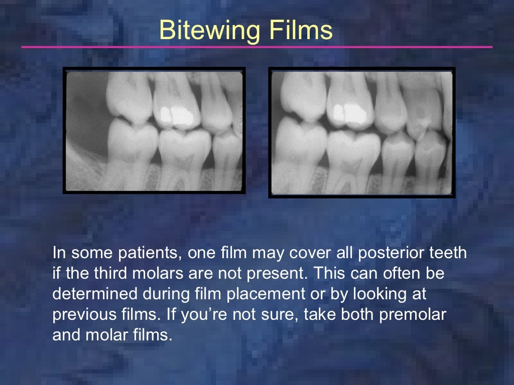 radiologybitewingtechnique