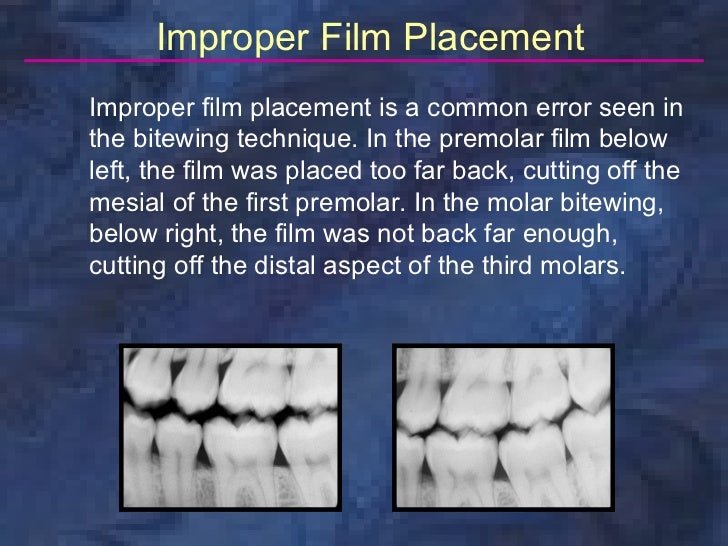 radiologybitewingtechnique