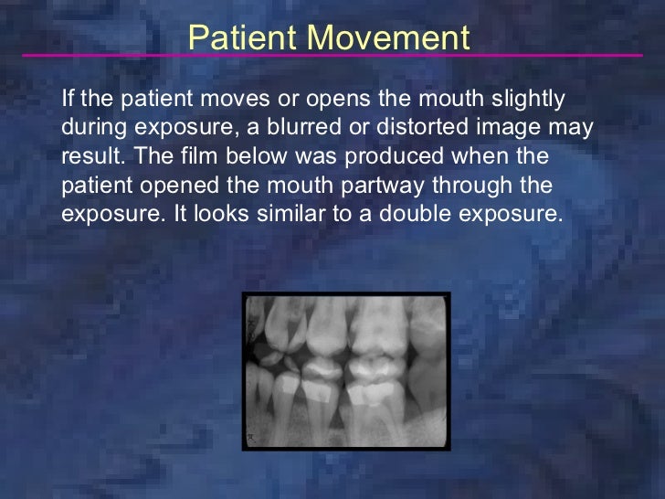 radiologybitewingtechnique