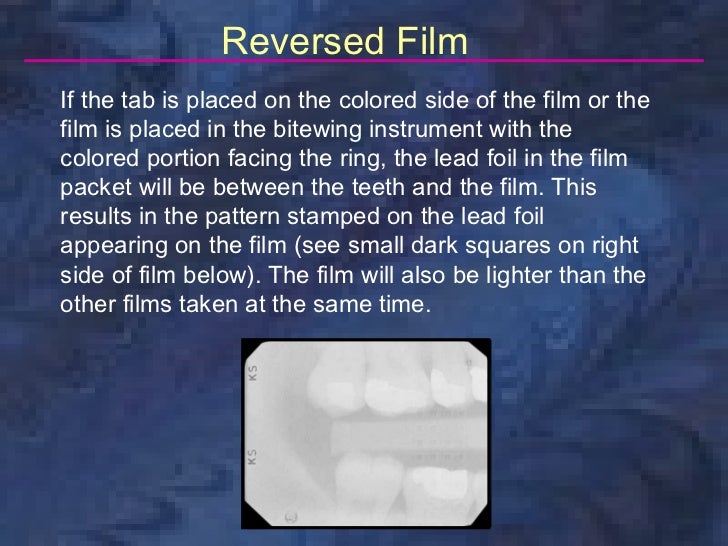 radiologybitewingtechnique