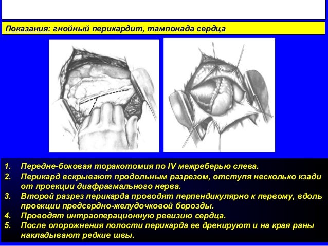 3 основы торакальной хирургии 2014