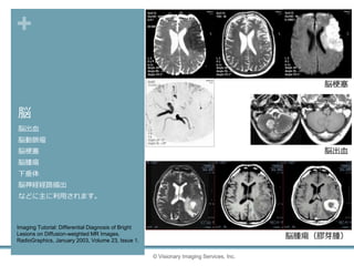 +
脳
脳出血
脳動脈瘤
脳梗塞
脳腫瘍
下垂体
脳神経経路描出
などに主に利用されます。
© Visionary Imaging Services, Inc.
Imaging Tutorial: Differential Diagnosis of Bright
Lesions on Diffusion-weighted MR Images.
RadioGraphics, January 2003, Volume 23, Issue 1.
脳梗塞
脳出血
脳腫瘍（膠芽腫）
 