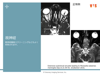 +
視神経
聴神経腫瘍スクリーニングなどもよく
利用されます。
© Visionary Imaging Services, Inc.
Extensive subclinical sinusitis leading to Moraxella osloensis
meningitis:Sep 21;6:39-42. eCollection 2016.
正常例
 