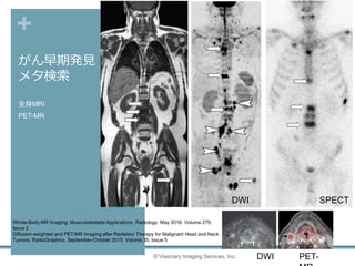 +
がん早期発見
メタ検索
全身MRI
PET-MR
© Visionary Imaging Services, Inc.
Whole-Body MR Imaging: Musculoskeletal Applications. Radiology. May 2016. Volume 279,
Issue 2
Diffusion-weighted and PET/MR Imaging after Radiation Therapy for Malignant Head and Neck
Tumors. RadioGraphics. September-October 2015. Volume 35, Issue 5
SPECTDWI
PET-DWI
 