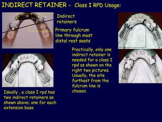3_2019_10_12!08_49_31_PM partial denture .ppt