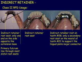 Continuous Rest Rpd 3_2019_10_12!08_49_31_PM partial denture .ppt