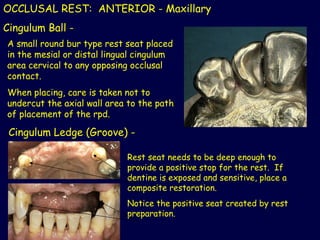 Chevron Rest Rpd 3_2019_10_12!08_49_31_PM partial denture .ppt