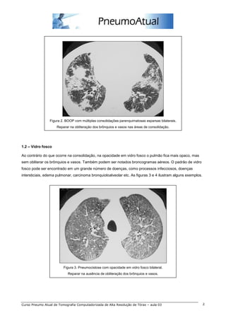 Figura 2. BOOP com múltiplas consolidações parenquimatosas esparsas bilaterais. 
Reparar na obliteração dos brônquios e vasos nas áreas de consolidação. 
1.2 – Vidro fosco 
Ao contrário do que ocorre na consolidação, na opacidade em vidro fosco o pulmão fica mais opaco, mas 
sem obliterar os brônquios e vasos. Também podem ser notados broncogramas aéreos. O padrão de vidro 
fosco pode ser encontrado em um grande número de doenças, como processos infecciosos, doenças 
intersticiais, edema pulmonar, carcinoma bronquioloalveolar etc. As figuras 3 e 4 ilustram alguns exemplos. 
Figura 3. Pneumocistose com opacidade em vidro fosco bilateral. 
Reparar na ausência de obliteração dos brônquios e vasos. 
Curso Pneumo Atual de Tomografia Computadorizada de Alta Resolução de Tórax – aula 03 2 
 