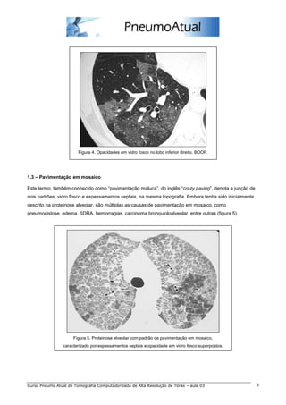 Figura 4. Opacidades em vidro fosco no lobo inferior direito. BOOP. 
1.3 – Pavimentação em mosaico 
Este termo, também conhecido como “pavimentação maluca”, do inglês “crazy paving”, denota a junção de 
dois padrões, vidro fosco e espessamentos septais, na mesma topografia. Embora tenha sido inicialmente 
descrito na proteinose alveolar, são múltiplas as causas de pavimentação em mosaico, como 
pneumocistose, edema, SDRA, hemorragias, carcinoma bronquioloalveolar, entre outras (figura 5). 
Figura 5. Proteinose alveolar com padrão de pavimentação em mosaico, 
caracterizado por espessamentos septais e opacidade em vidro fosco superpostos. 
Curso Pneumo Atual de Tomografia Computadorizada de Alta Resolução de Tórax – aula 03 3 
 