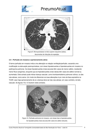 Figura 9. Bronquiectasias no lobo superior esquerdo (setas), 
decorrentes de infecções de repetição. 
2.4 – Perfusão em mosaico e aprisionamento aéreo 
O termo perfusão em mosaico indica uma alteração na relação ventilação/perfusão, causando uma 
modificação na atenuação parenquimatosa, com áreas hipoatenuantes e hiperatenuantes em mosaico no 
parênquima pulmonar. As áreas hipoatenuantes (mais escuras) têm vasos de menor calibre, recebendo 
menor fluxo sangüíneo, enquanto que as hiperatenuantes (mais claras) têm vasos de calibre normal ou 
aumentado. Este achado pode indicar doença vascular, como tromboembolismo pulmonar crônico, ou das 
vias aéreas, como asma. Um modo de diferenciar as duas alterações é por meio da fase expiratória na 
TCAR: caso haja aprisionamento de ar a doença deve ser das vias aéreas; em caso contrário, do leito 
vascular. As figuras 10 a 12 ilustram estes achados. 
Figura 10. Perfusão pulmonar em mosaico, com áreas hipo e hiperatenuantes. 
As hipoatenuantes (mais escuras) têm vasos de calibre reduzido. 
Curso Pneumo Atual de Tomografia Computadorizada de Alta Resolução de Tórax – aula 03 6 
 