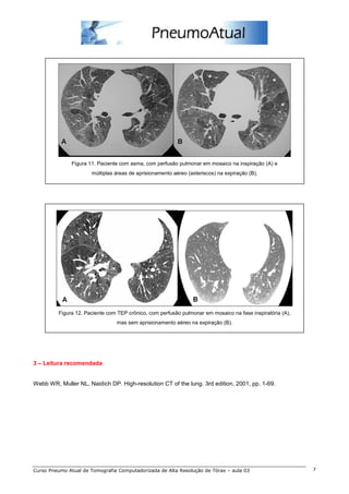 Figura 11. Paciente com asma, com perfusão pulmonar em mosaico na inspiração (A) e 
múltiplas áreas de aprisionamento aéreo (asteriscos) na expiração (B). 
Figura 12. Paciente com TEP crônico, com perfusão pulmonar em mosaico na fase inspiratória (A), 
mas sem aprisionamento aéreo na expiração (B). 
3 – Leitura recomendada 
Webb WR, Muller NL, Naidich DP. High-resolution CT of the lung. 3rd edition, 2001, pp. 1-69. 
Curso Pneumo Atual de Tomografia Computadorizada de Alta Resolução de Tórax – aula 03 7 
