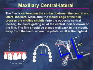 Maxillary Central-lateral
The film is centered on the contact between the central and
lateral incisors. Make sure the mesial edge of the film
crosses the midline slightly (into the opposite central
incisor), to insure getting all of the central incisor crown on
the film. The film should be placed well back in the mouth,
away from the teeth, where the palatal vault is the highest.
 