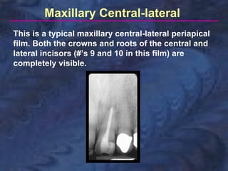 Maxillary Central-lateral
This is a typical maxillary central-lateral periapical
film. Both the crowns and roots of the central and
lateral incisors (#’s 9 and 10 in this film) are
completely visible.
 