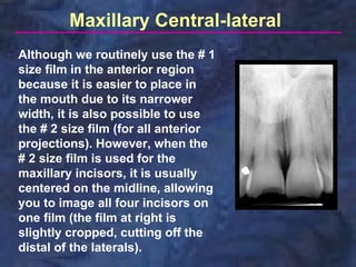 Maxillary Central-lateral
Although we routinely use the # 1
size film in the anterior region
because it is easier to place in
the mouth due to its narrower
width, it is also possible to use
the # 2 size film (for all anterior
projections). However, when the
# 2 size film is used for the
maxillary incisors, it is usually
centered on the midline, allowing
you to image all four incisors on
one film (the film at right is
slightly cropped, cutting off the
distal of the laterals).
 