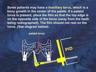 Some patients may have a maxillary torus, which is a
bony growth in the center of the palate. If a palatal
torus is present, place the film so that the top edge is
on the opposite side of the torus (away from the teeth
being radiographed). The film should not rest on the
torus. (See diagram below).

              palatal torus
 
