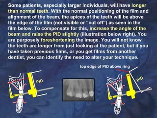 Some patients, especially larger individuals, will have longer
than normal teeth. With the normal positioning of the film and
alignment of the beam, the apices of the teeth will be above
the edge of the film (not visible or “cut off”) as seen in the
film below. To compensate for this, increase the angle of the
beam and raise the PID slightly (illustration below right). You
are purposely foreshortening the image. You will not know
the teeth are longer from just looking at the patient, but if you
have taken previous films, or you get films from another
dentist, you can identify the need to alter your technique.
                                 top edge of PID above ring
 