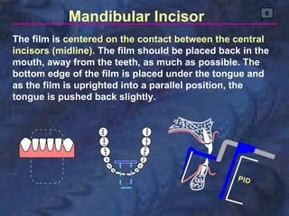 Mandibular Incisor                          0



The film is centered on the contact between the central
incisors (midline). The film should be placed back in the
mouth, away from the teeth, as much as possible. The
bottom edge of the film is placed under the tongue and
as the film is uprighted into a parallel position, the
tongue is pushed back slightly.
 