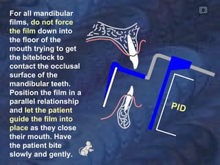 0
For all mandibular
films, do not force
the film down into
the floor of the
mouth trying to get
the biteblock to
contact the occlusal
surface of the
mandibular teeth.
Position the film in a
parallel relationship
and let the patient
guide the film into
place as they close
their mouth. Have
the patient bite
slowly and gently.
 