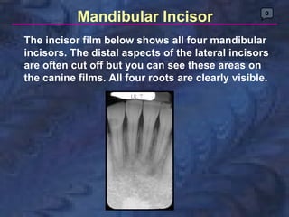 Mandibular Incisor                       0




The incisor film below shows all four mandibular
incisors. The distal aspects of the lateral incisors
are often cut off but you can see these areas on
the canine films. All four roots are clearly visible.
 