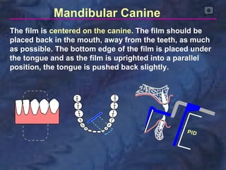 Mandibular Canine                         0



The film is centered on the canine. The film should be
placed back in the mouth, away from the teeth, as much
as possible. The bottom edge of the film is placed under
the tongue and as the film is uprighted into a parallel
position, the tongue is pushed back slightly.
 