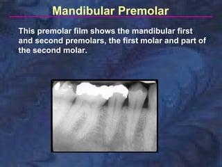 Mandibular Premolar
This premolar film shows the mandibular first
and second premolars, the first molar and part of
the second molar.
 