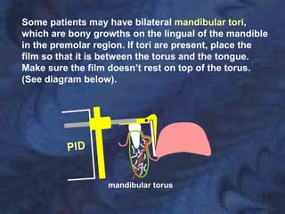 Some patients may have bilateral mandibular tori,
which are bony growths on the lingual of the mandible
in the premolar region. If tori are present, place the
film so that it is between the torus and the tongue.
Make sure the film doesn’t rest on top of the torus.
(See diagram below).




                  mandibular torus
 
