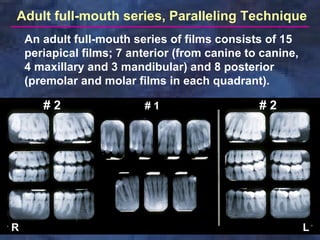 Adult full-mouth series, Paralleling Technique
    An adult full-mouth series of films consists of 15
    periapical films; 7 anterior (from canine to canine,
    4 maxillary and 3 mandibular) and 8 posterior
    (premolar and molar films in each quadrant).

       #2                 #1                    #2




R                                                          L
 