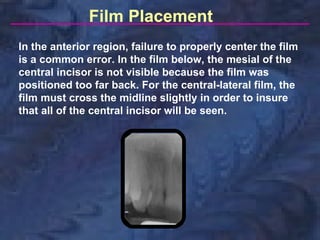 Film Placement
In the anterior region, failure to properly center the film
is a common error. In the film below, the mesial of the
central incisor is not visible because the film was
positioned too far back. For the central-lateral film, the
film must cross the midline slightly in order to insure
that all of the central incisor will be seen.
 
