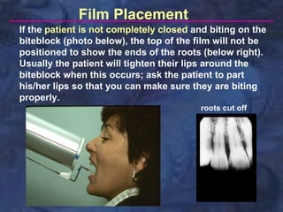 Film Placement
If the patient is not completely closed and biting on the
biteblock (photo below), the top of the film will not be
positioned to show the ends of the roots (below right).
Usually the patient will tighten their lips around the
biteblock when this occurs; ask the patient to part
his/her lips so that you can make sure they are biting
properly.
                                         roots cut off
 